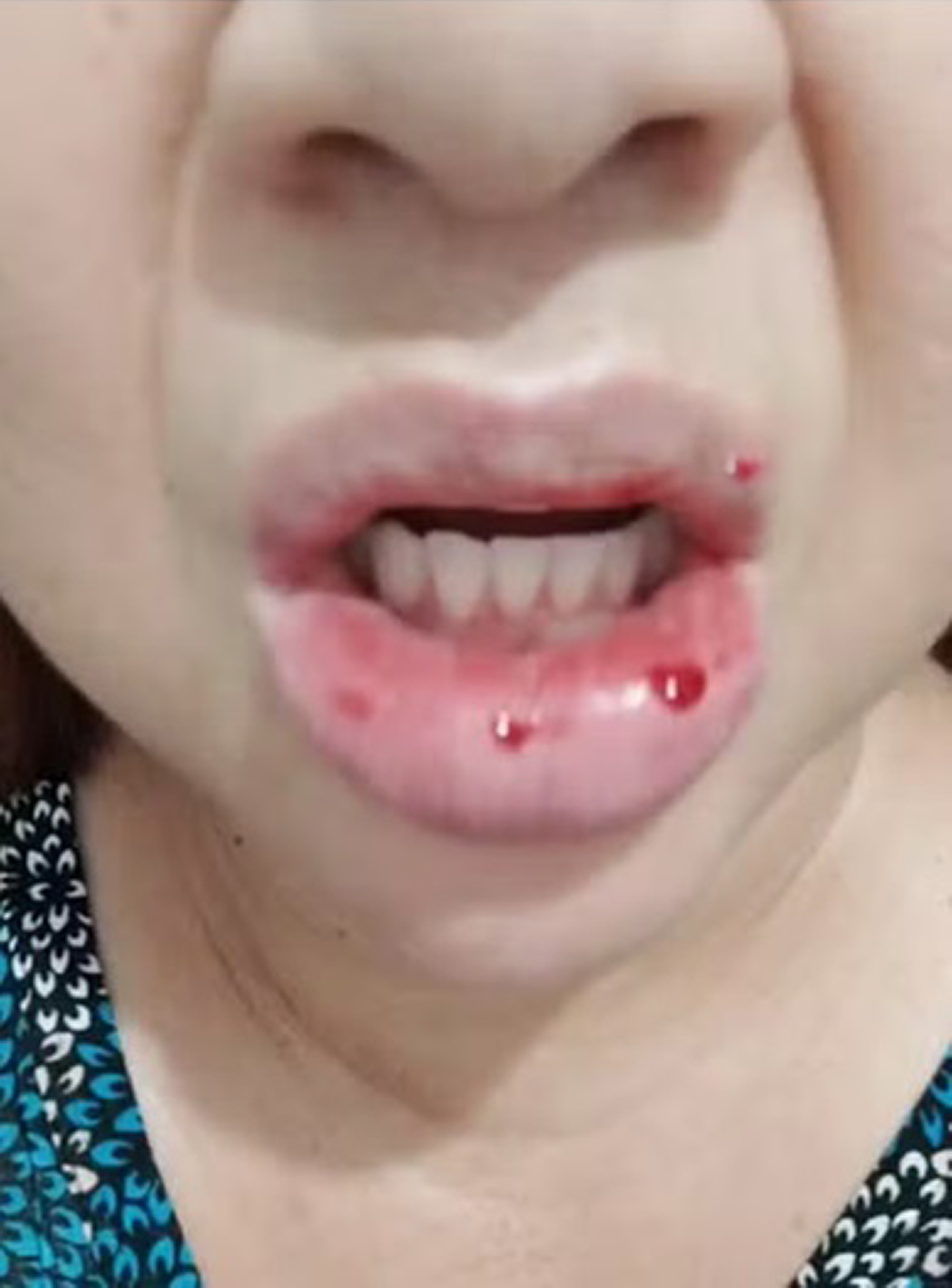 Denise Correia Santiago, 45, shows her lips in undated photo. She suffered an allergic reaction after using toothpaste, in Miracatu, Brazil. Note: Private photo taken from social media. Denise Correia Santiago