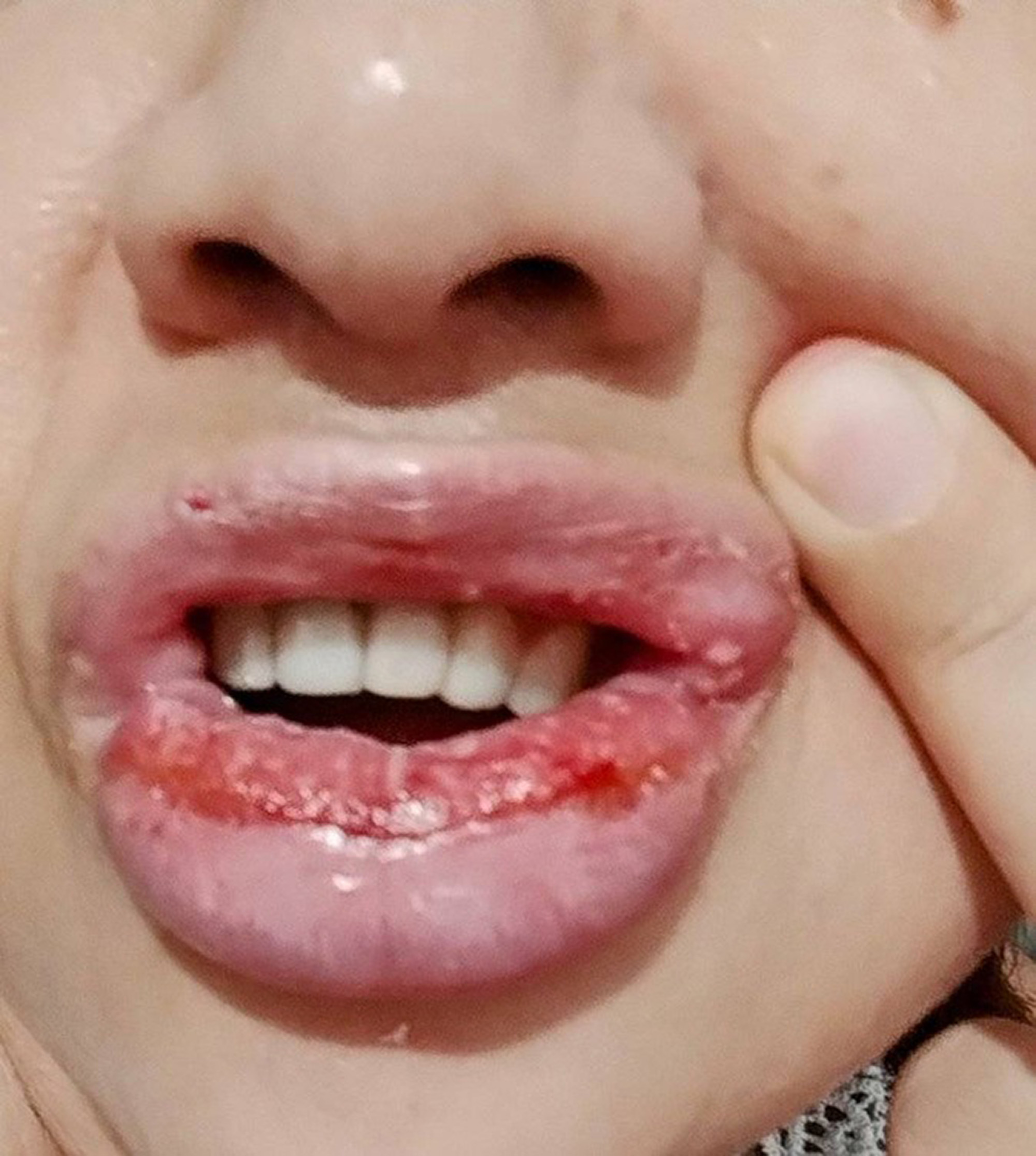 Denise Correia Santiago, 45, shows her lips in undated photo. She suffered an allergic reaction after using toothpaste, in Miracatu, Brazil. Note: Private photo taken from social media. Denise Correia Santiago