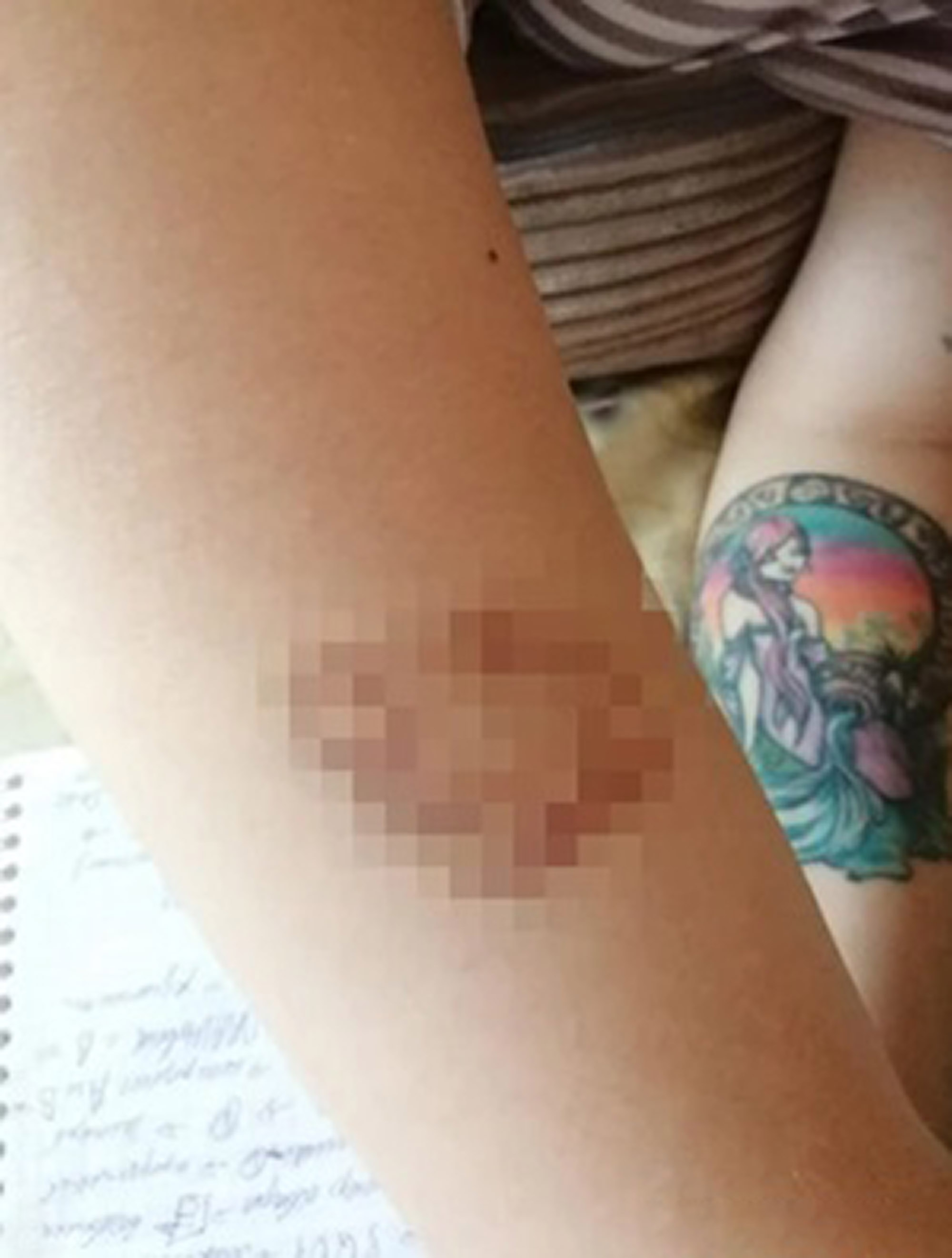 Picture shows Tatyana's bruises, undated. She was one of the first victims. Note: Private photo taken from local media. Tatyana's bruises