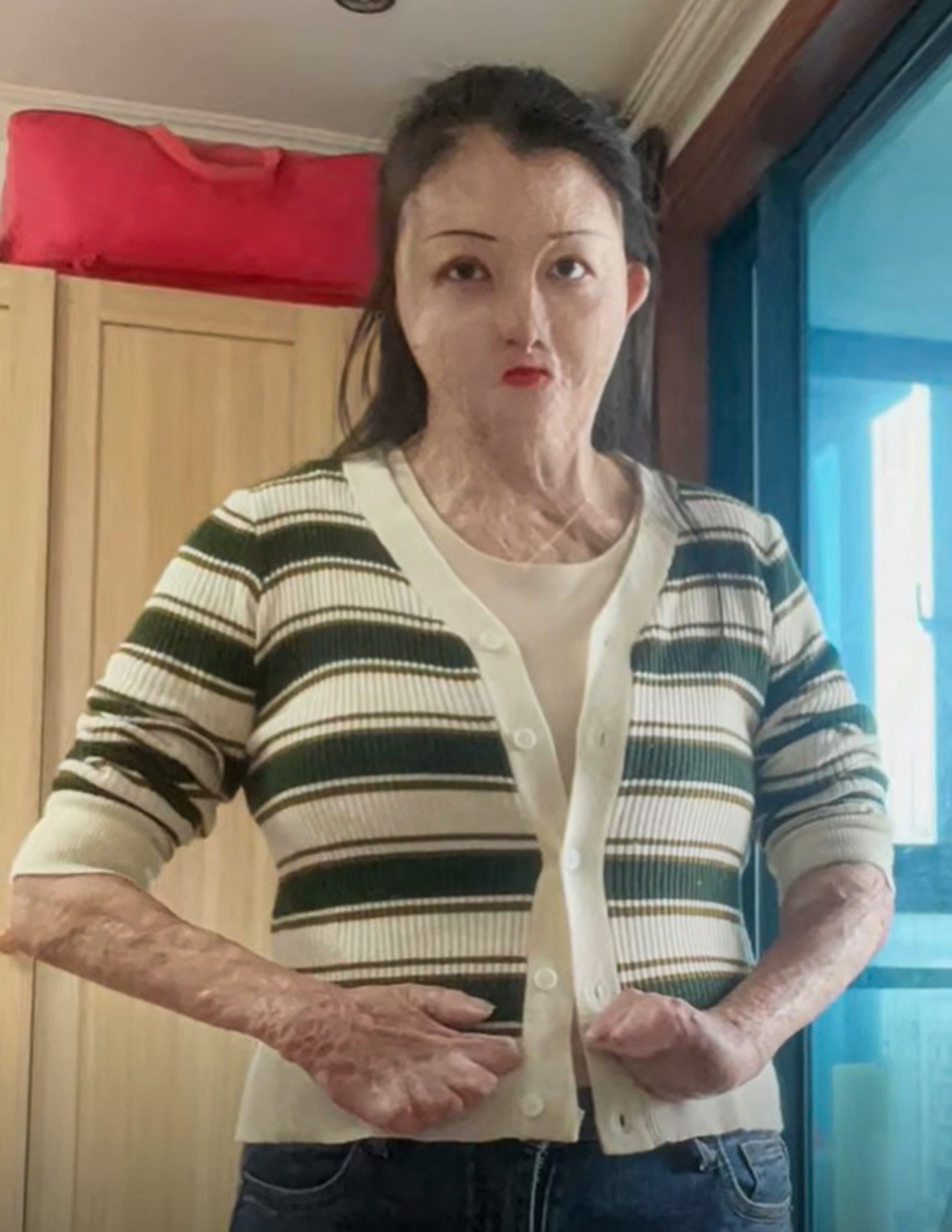 Picture shows Dai Wanyue, undated. The woman with 95 percent burns from Guangshui, China, shares same birthday as her boyfriend. Note: Private photo taken from social media. Dai Wanyue