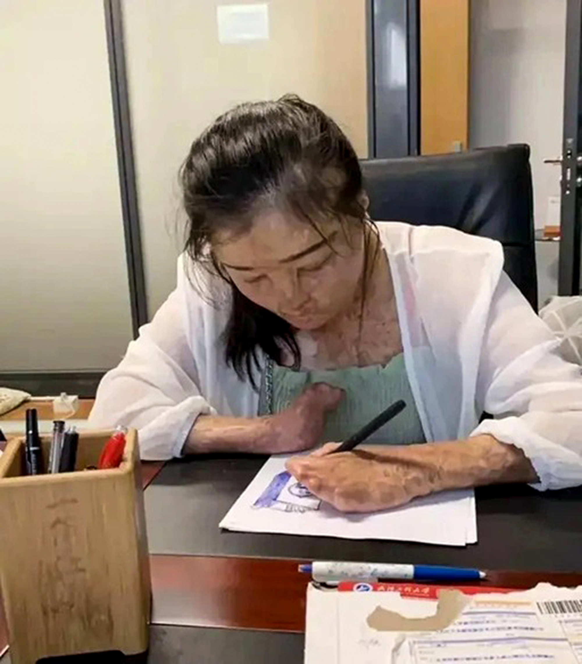 Picture shows Dai Wanyue, undated. The woman with 95 percent burns from Guangshui, China, shares same birthday as her boyfriend. Note: Private photo taken from local media. Dai Wanyue
