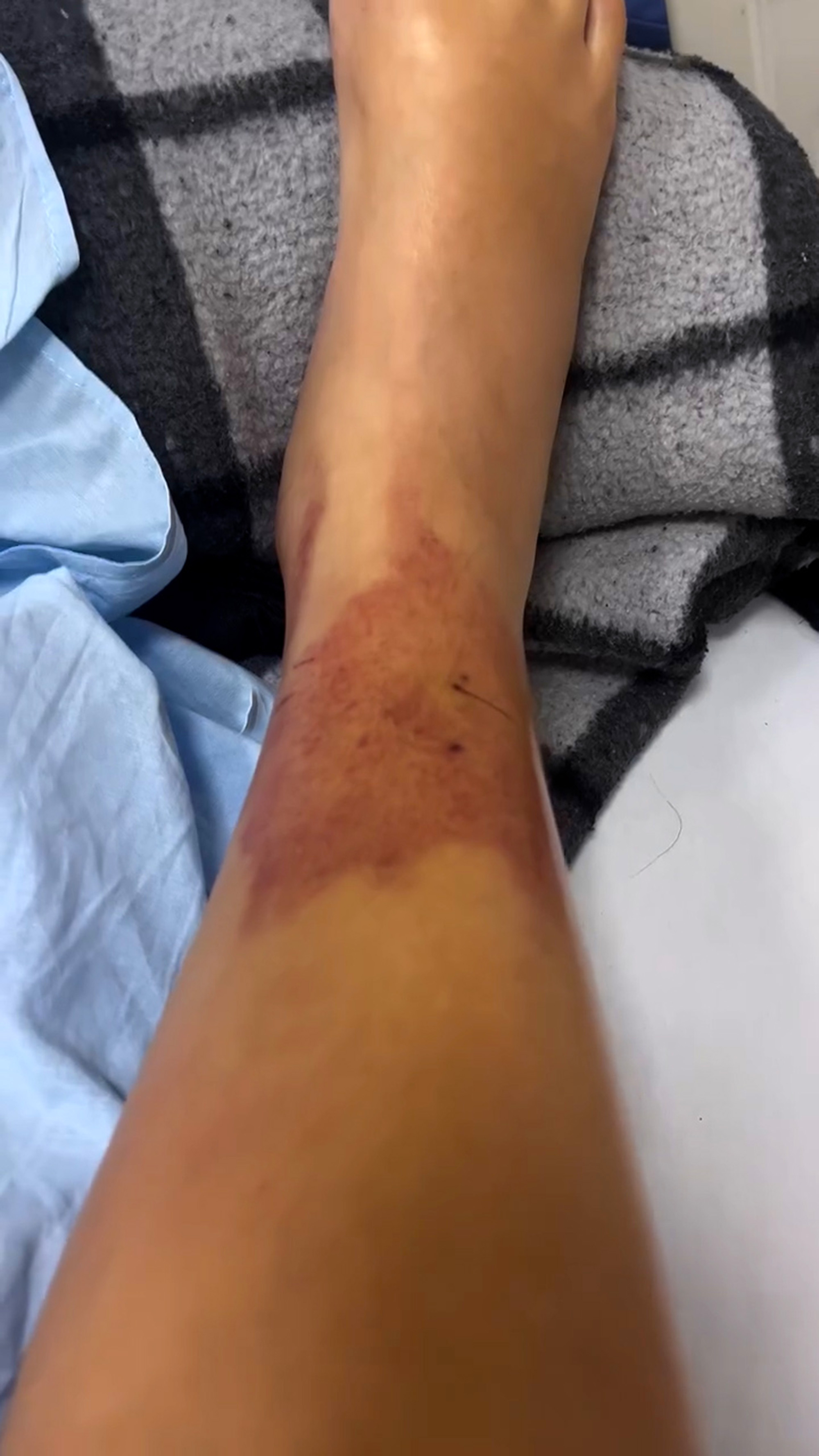 Picture shows Sany Galdino's leg after a snake bite in Anapolis, Brazil, undated. She received antivenom at hospital. Note: Photo is a screenshot from a video. Sany Galdino's leg