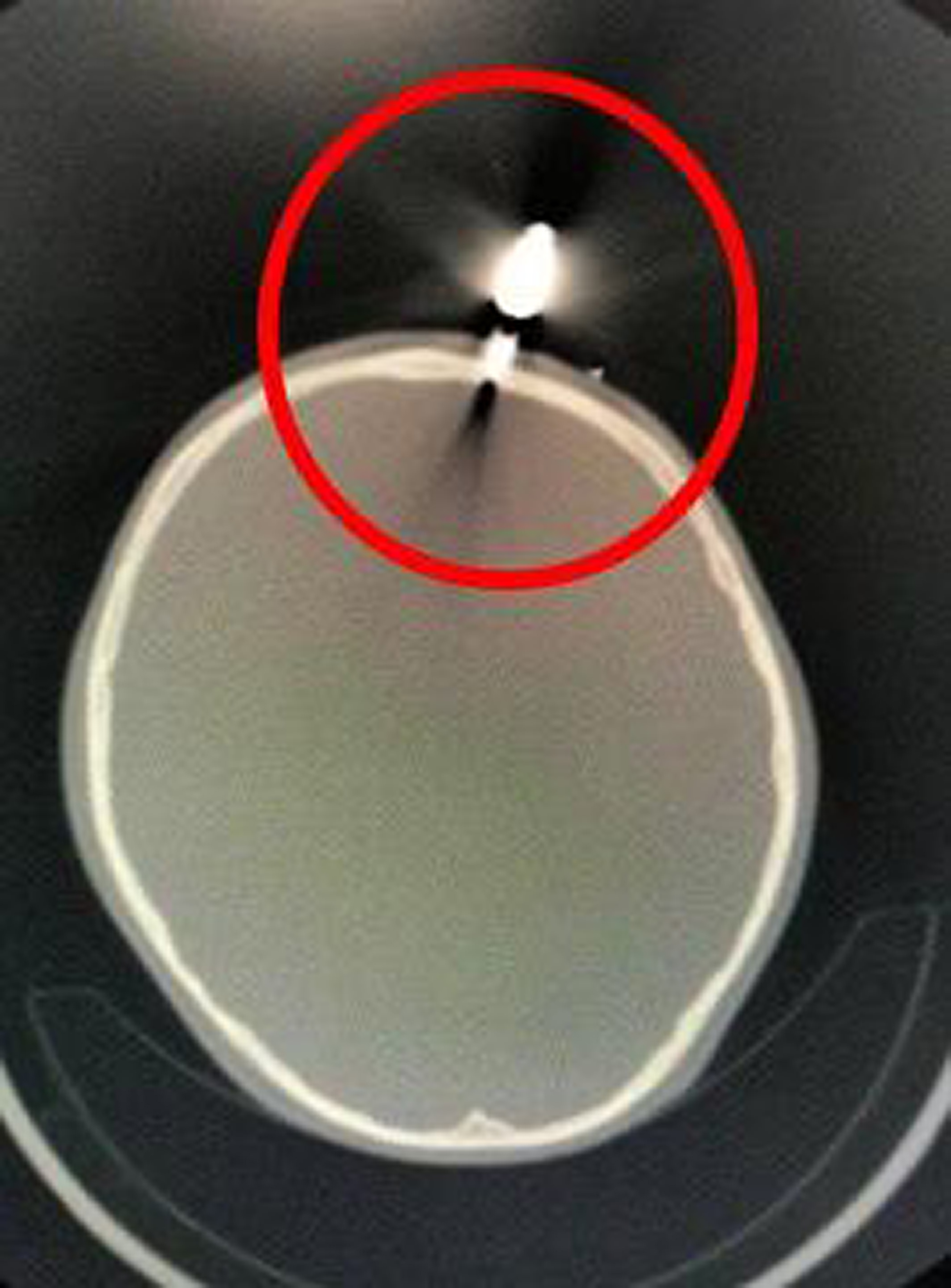 dart stuck in 10-year-old boy's skull