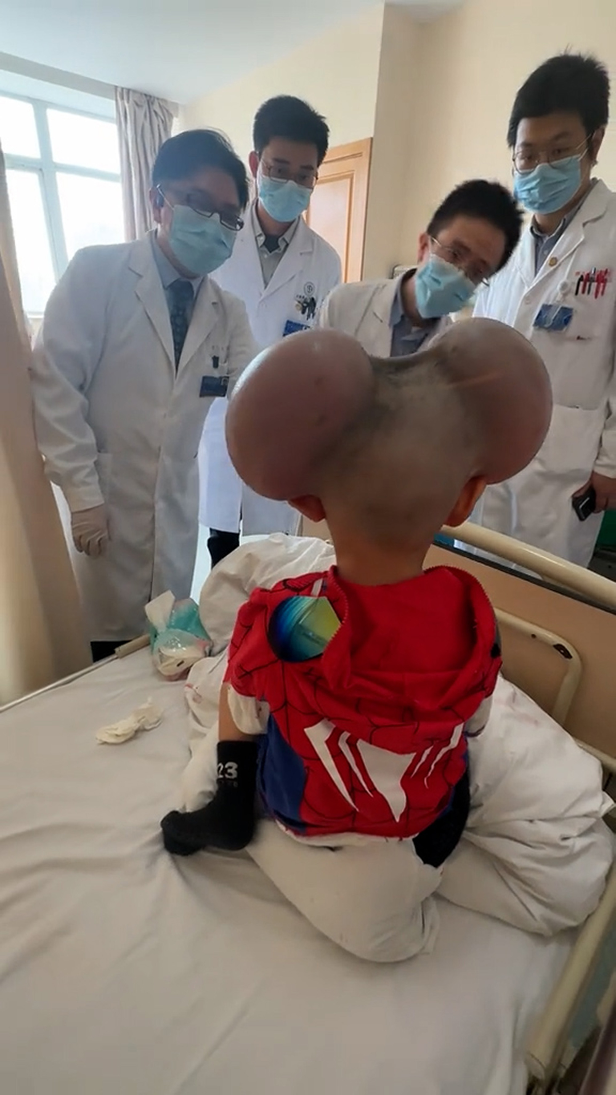 three-year-old boy who was teased for looking like Mickey Mouse