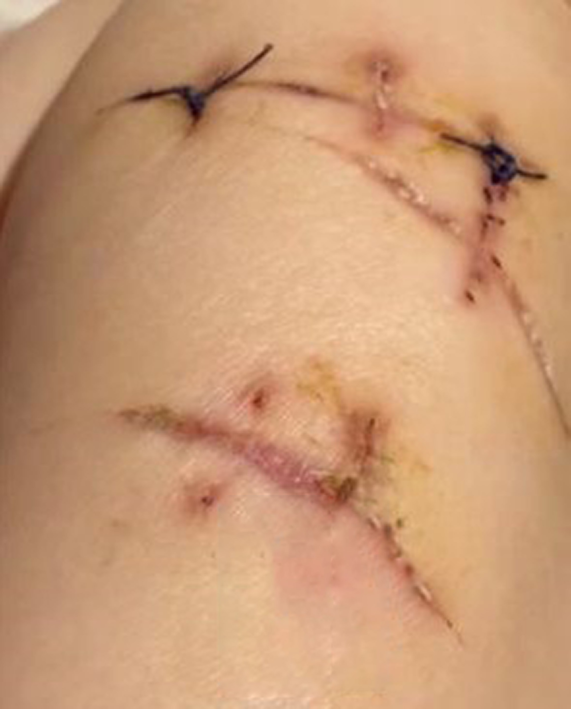 Photo shows injuries of woman who survived after being stabbed 22 times in the chest Hangzhou in Zhejiang Province, China, on 22 May 2025. She survived thanks to her breast implants. Note: Private photo. Photo shows injuries of woman who survived after being stabbed 22 times in the chest