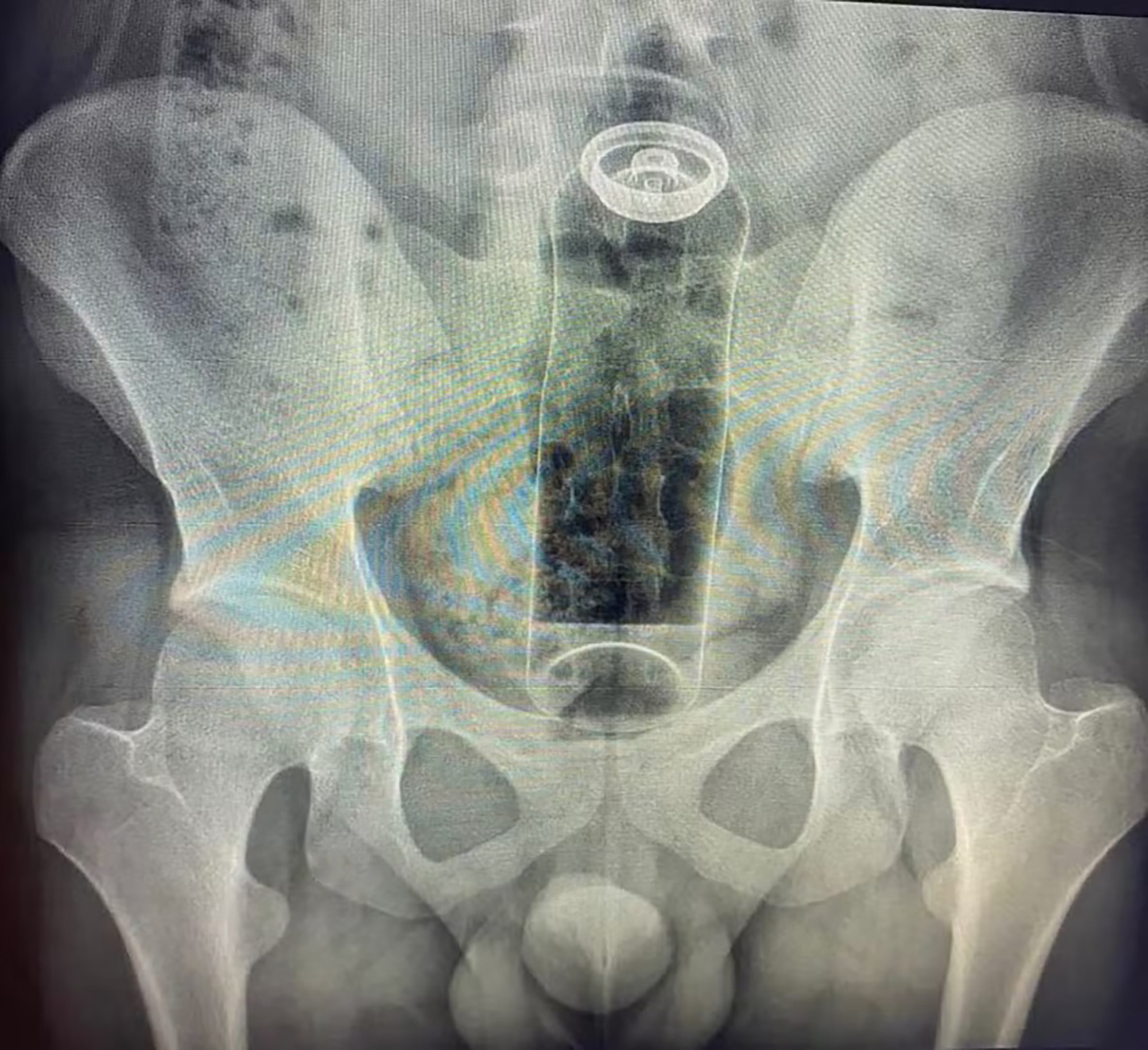 An x-ray image shows the deodorant stuffed in the bum, undated. A 19-year-old patient had inserted the item during a sexual game. Note: Private photo. An x-ray image shows the deodorant stuffed in the bum