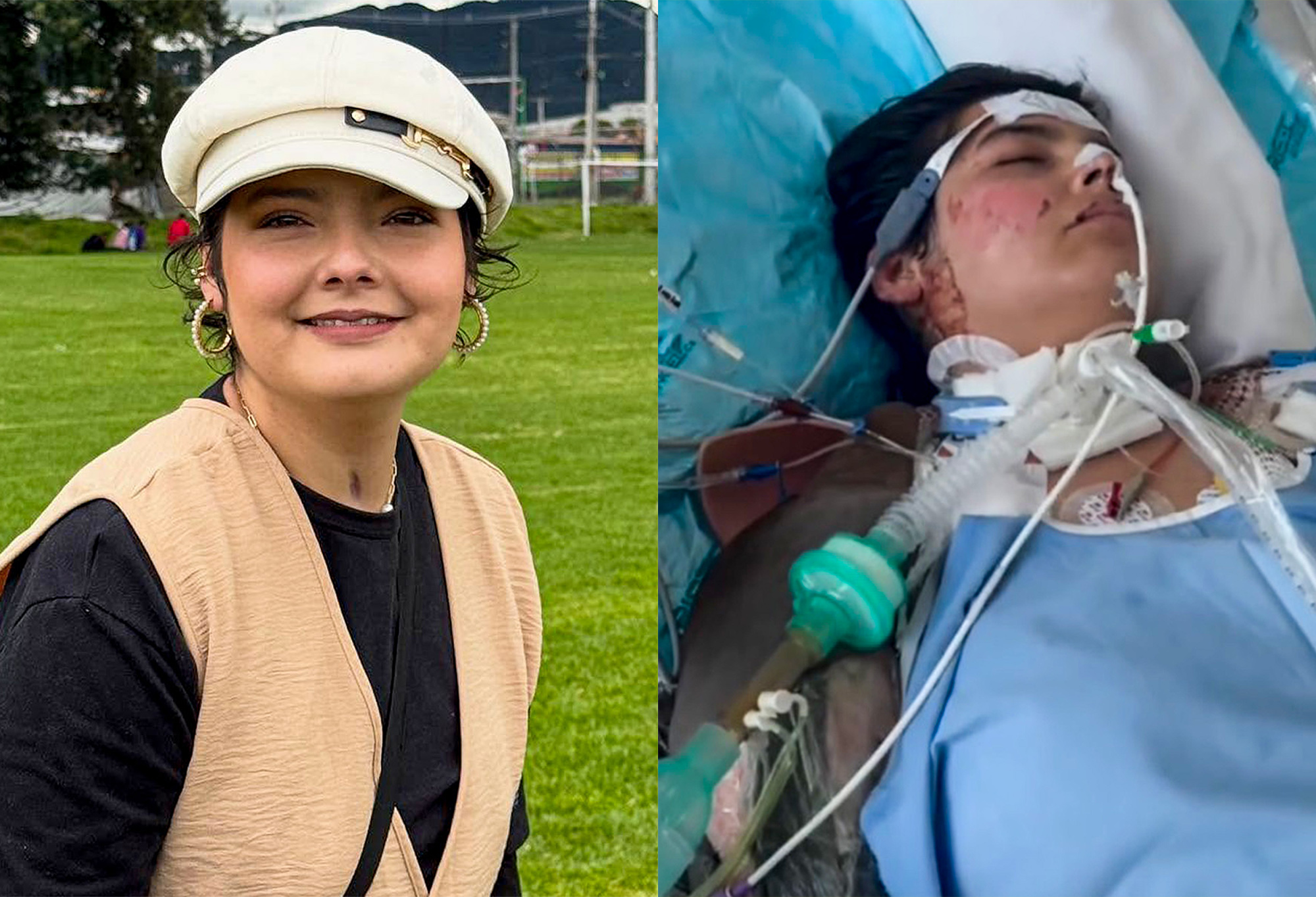 Photo shows Laura Villamil after recovery on the left and on the right in hospital, undated. She suffered severe burns over 90 percent of her body while performing at the well-known Andres Carne de Res restaurant in Chia, Cundinamarca in Colombia. 1747336711385-bd8sanuv.jpg