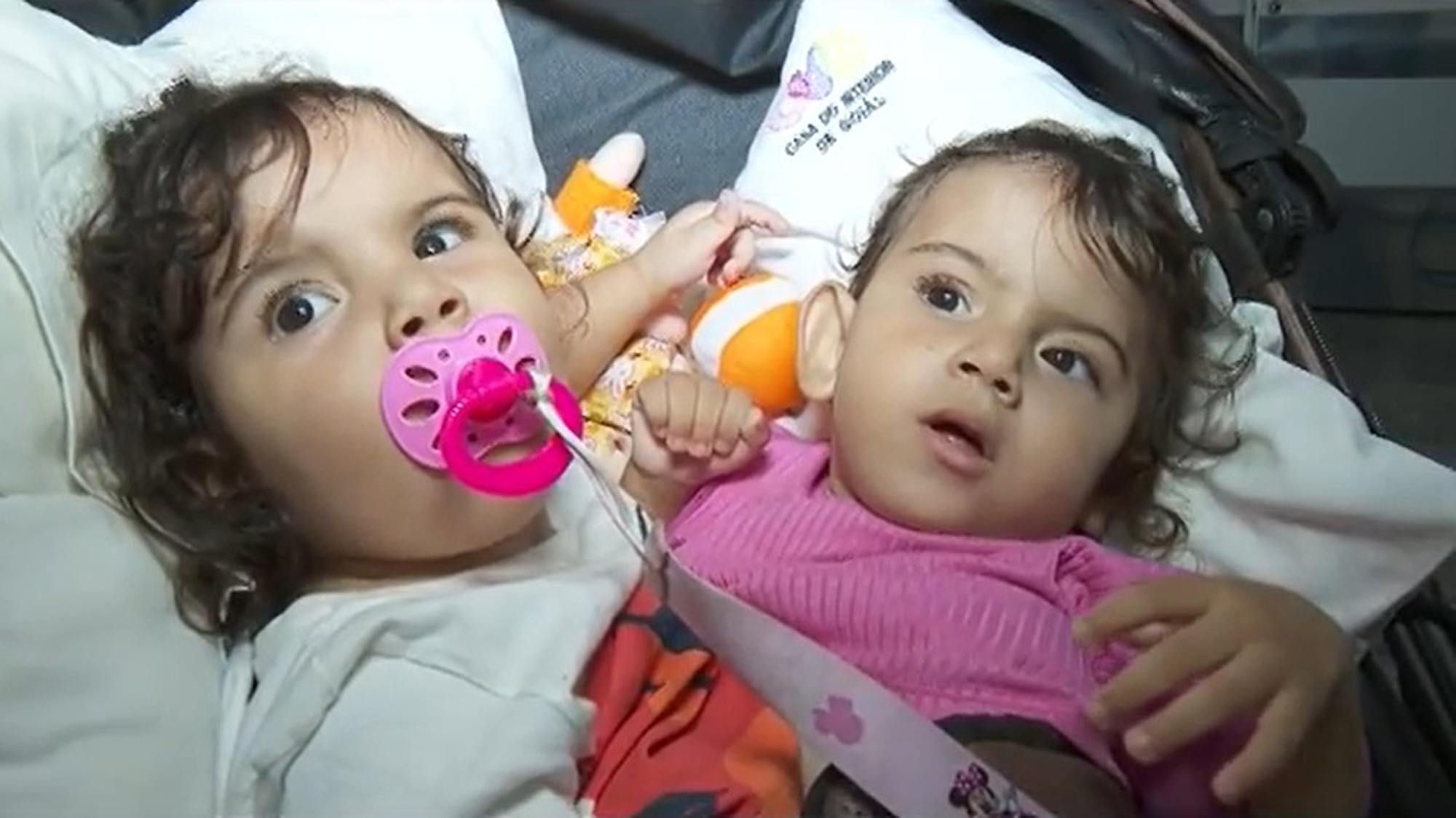 Picture shows Siamese twins Kiraz and Aruna, aged 1 year and 6 months, undated. They underwent surgery in Goiania, Brazil on May 10, 2025. Note: Image is a screenshot from video. (Newsflash/NX) 1747768904195-qrewuwzd.jpg