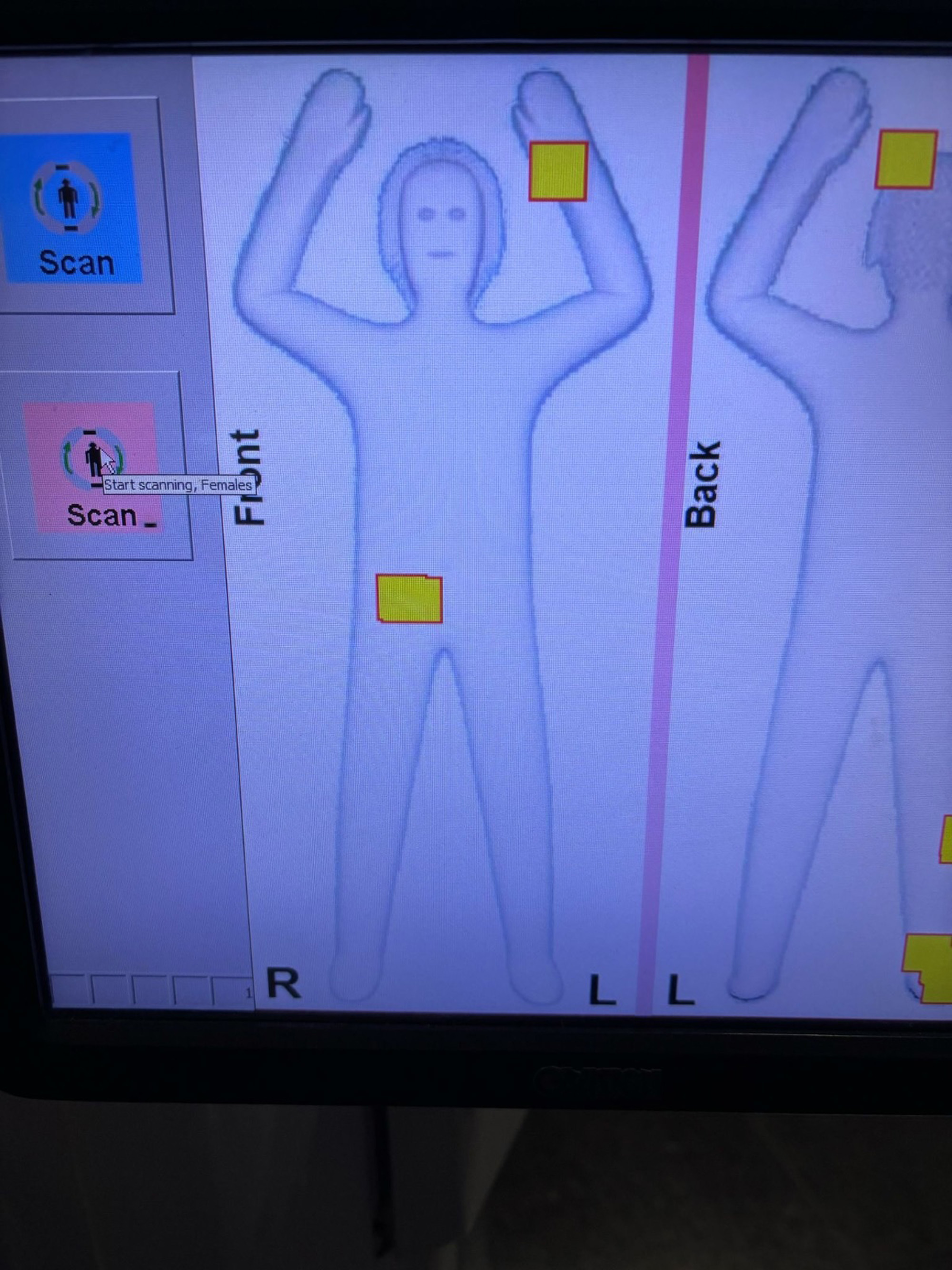 Picture shows an X-ray of the suspects, undated. Three women were caught smuggling gold in their privates at the Istanbul Airport, Turkey, on Apr.25, 2025. Note: Private photo taken from local media. (Newsflash/NX) 1747845329010-ok5av0ac.jpg